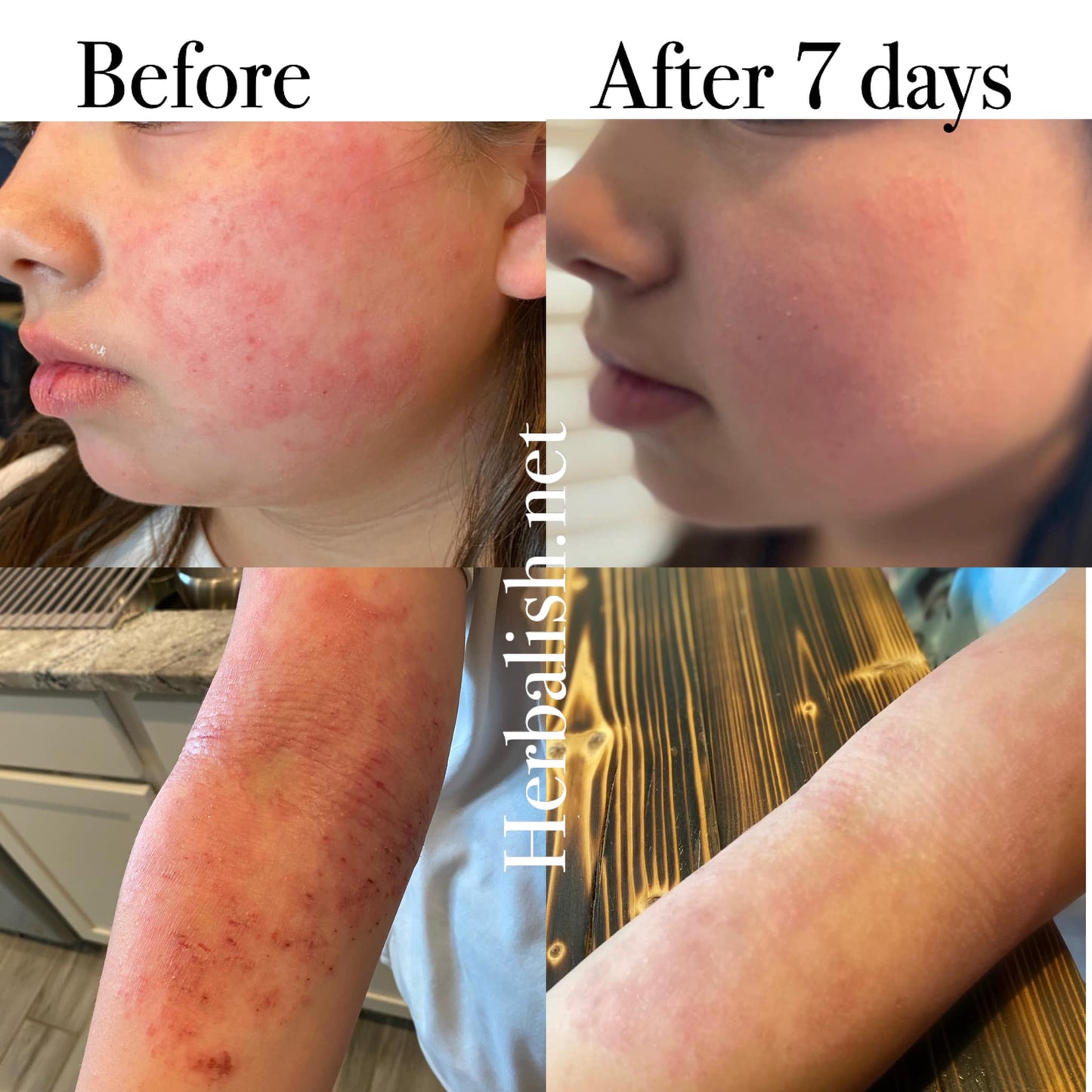 Sensitive Skin Duo (Eczema, Rash, Psoriasis, Baby)