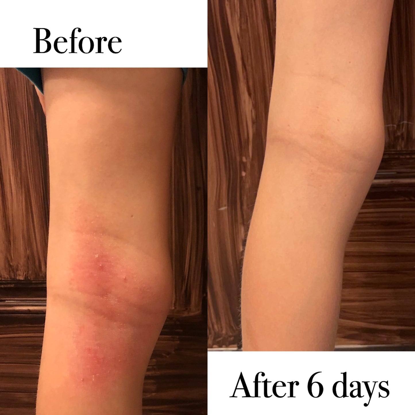 Sensitive Skin Duo (Eczema, Rash, Psoriasis, Baby)