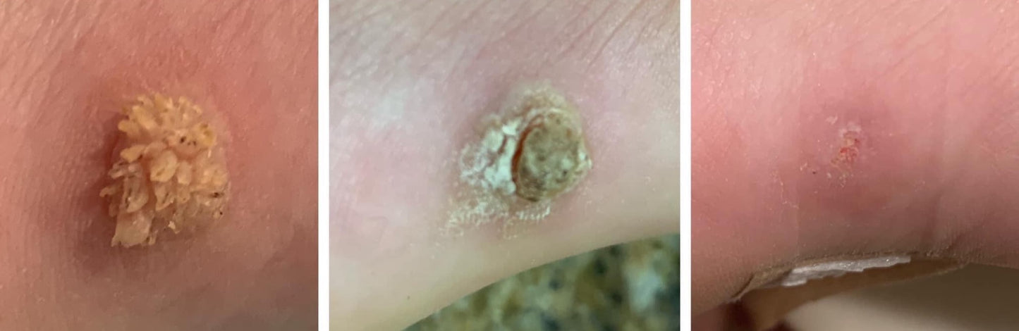 Bump Away (Molluscum-Warts-Skin tags)
