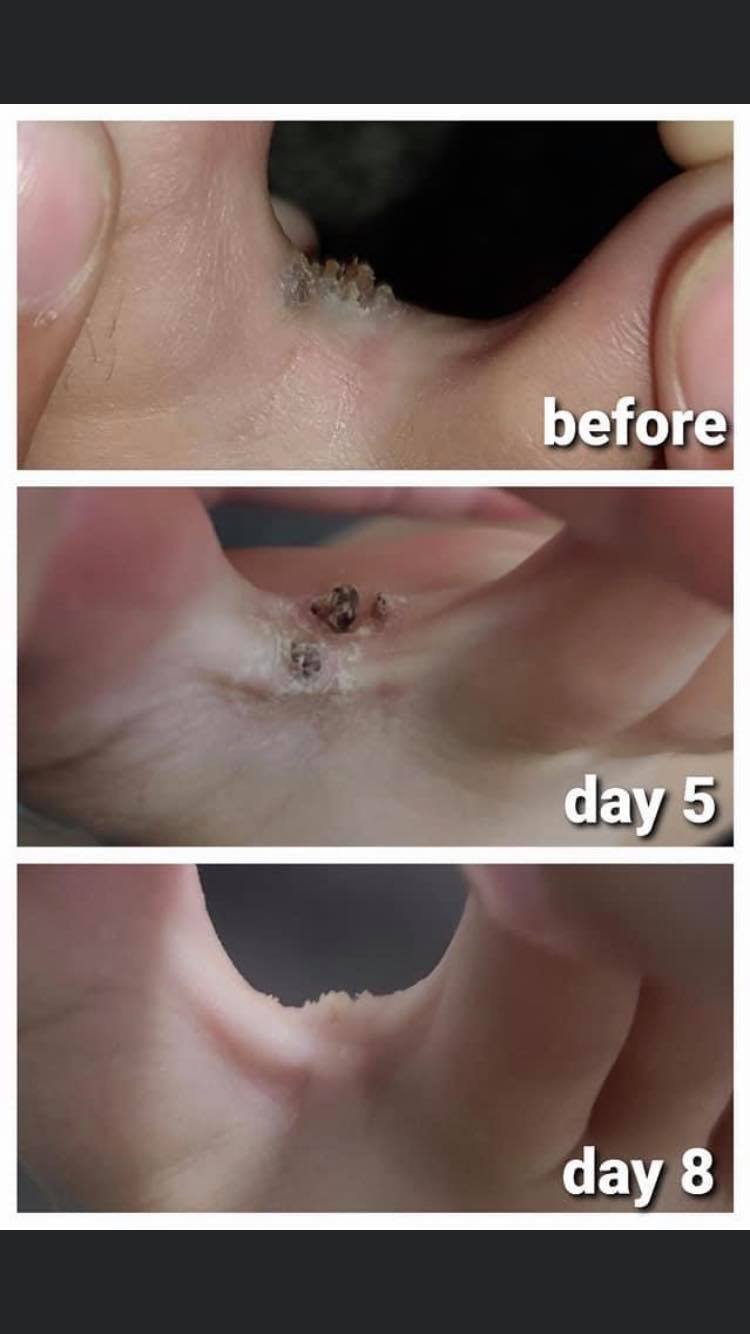 Bump Away (Molluscum-Warts-Skin tags)